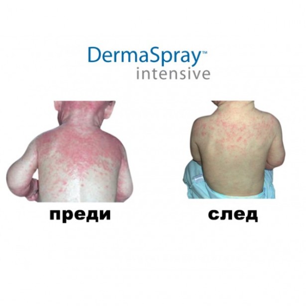 Dermaspray Intensive ( ДермаСпрей Интензив ) - Решението на всички кожни проблеми.